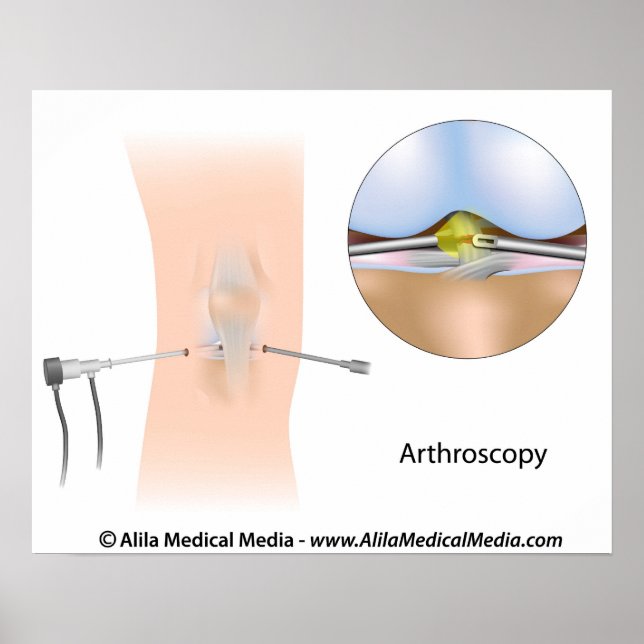 Knee arthroscopy diagram. poster (Front)