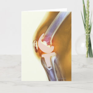 Knee replacement. Coloured X-ray of a total knee Card
