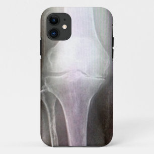 KNEE XRAY IPHONE COVER