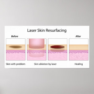 Laser skin resurfacing procedure poster