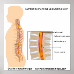 Lumbar epidural injection, labelled diagram. poster