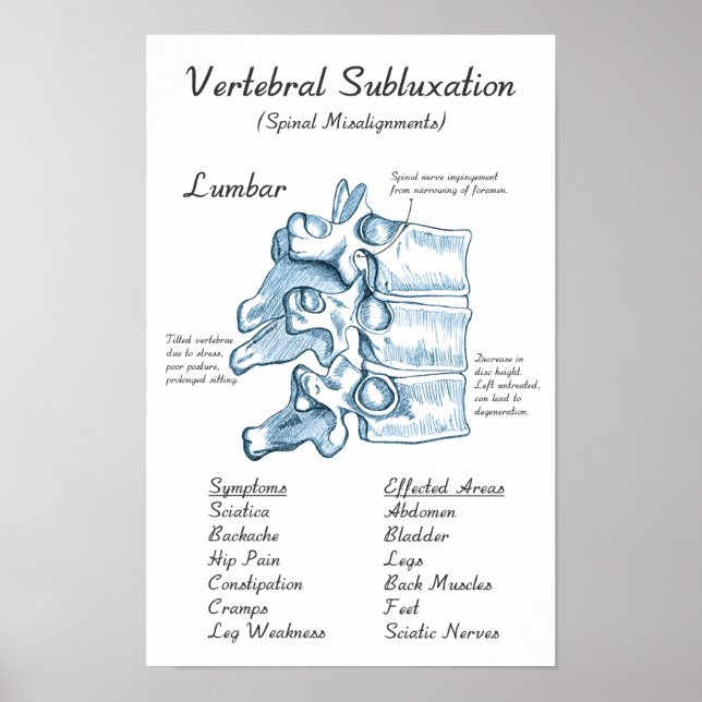 Lumbar Subluxation Chiropractic Art Poster (Front)