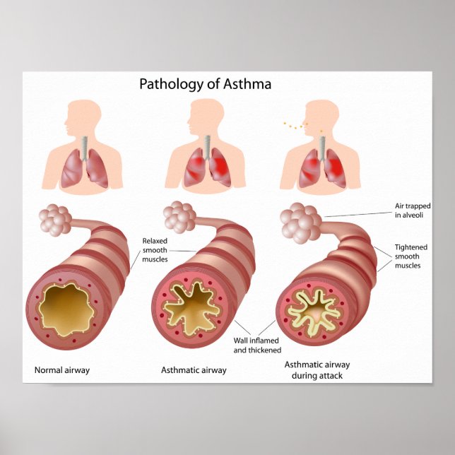 Lung disease Asthma Poster (Front)
