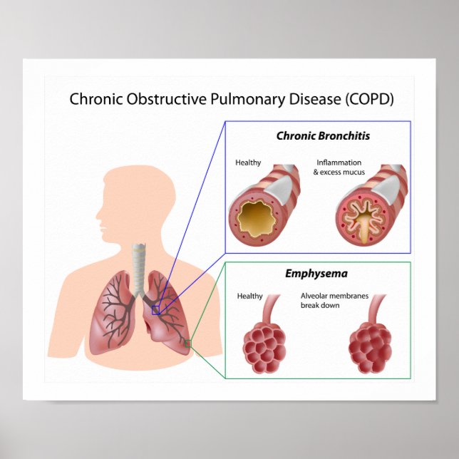 Lung disease (COPD) Poster (Front)