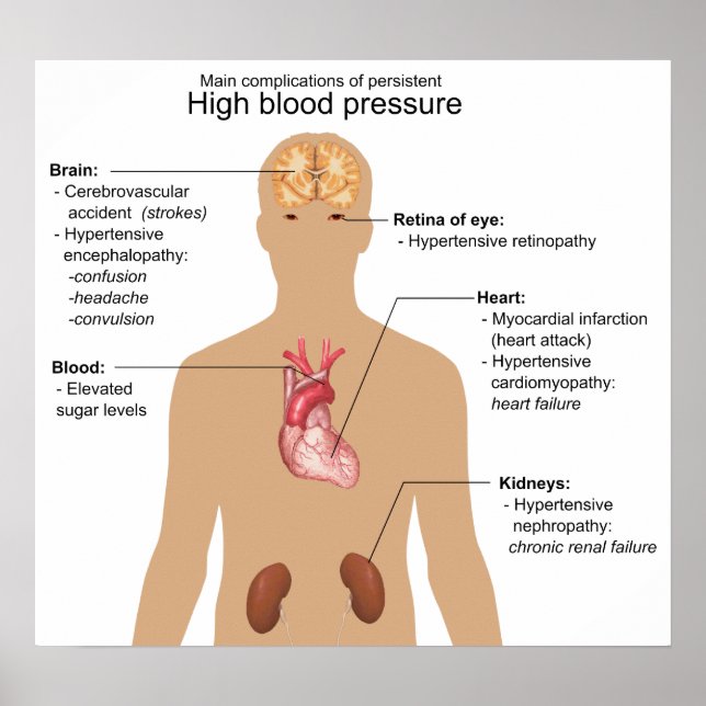 Main Complications of High Blood Pressure Chart (Front)