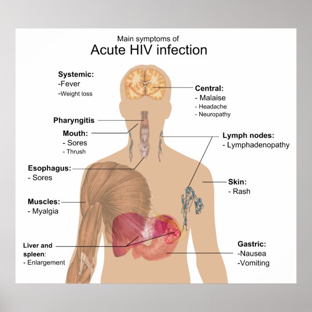 Main Symptoms of Acute HIV Infection Poster (Front)
