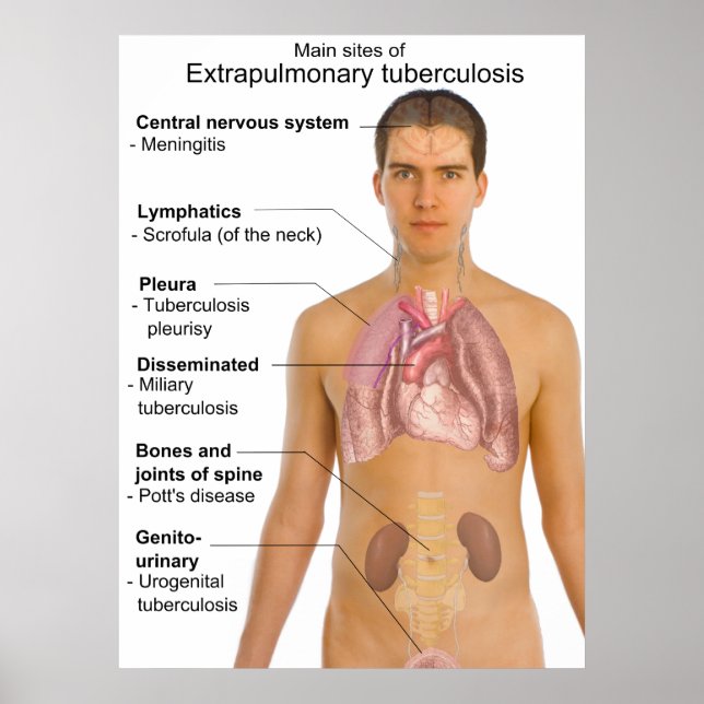 Main Symptoms of Extrapulmonary Tuberculosis Chart (Front)