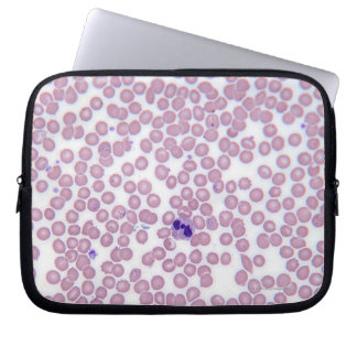 Malarial Blood Cells Laptop Sleeve