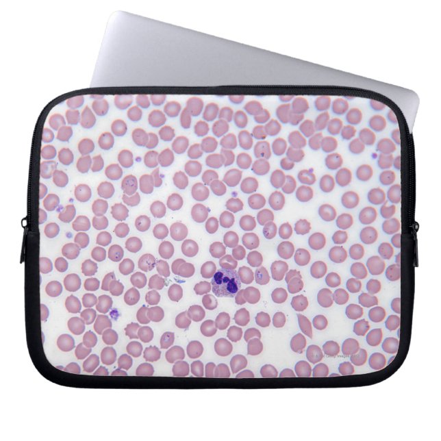 Malarial Blood Cells Laptop Sleeve (Front)