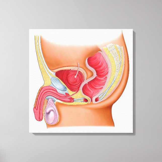 Medical Illustration Of A Rectourethral Fistula Canvas Print (Front)