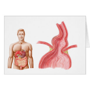 Medical Ilustration Of A Hiatal Hernia In The