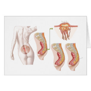 Medical Ilustration Of A Pilonidal Cyst