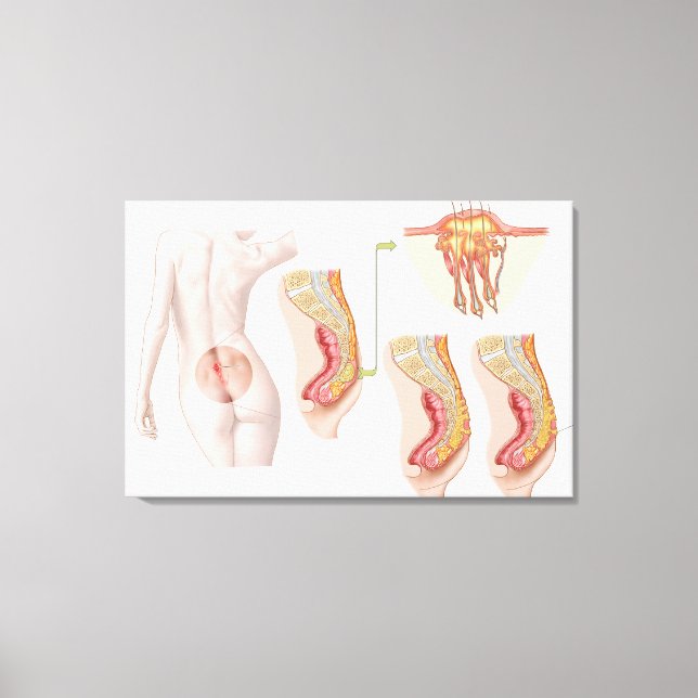 Medical Ilustration Of A Pilonidal Cyst Canvas Print (Front)