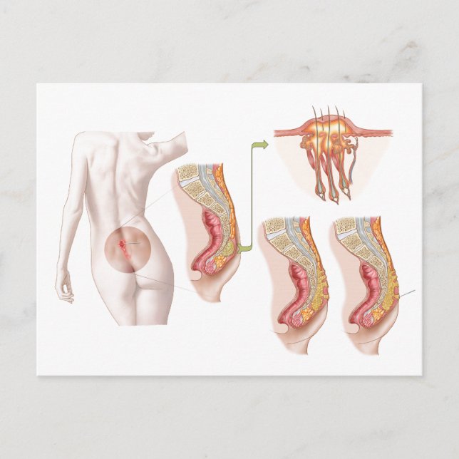 Medical Ilustration Of A Pilonidal Cyst Postcard (Front)