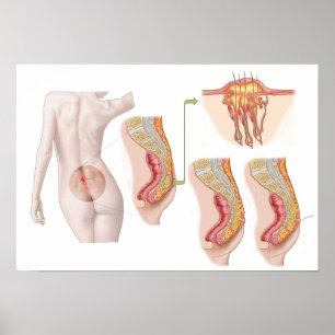 Medical Ilustration Of A Pilonidal Cyst Poster