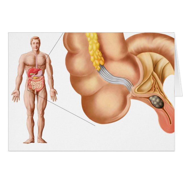Medical Ilustration Of An Appendix (Front Horizontal)