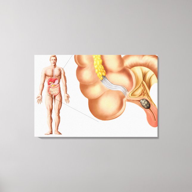 Medical Ilustration Of An Appendix Canvas Print (Front)
