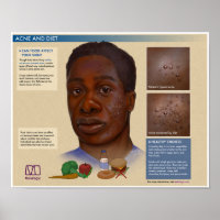 Melalogic Acne and Diet Medical Poster