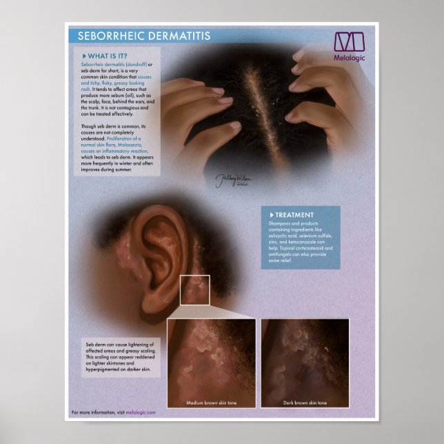 Melalogic Seborrheic Dermatitis (Dandruff) Medical Poster (Front)
