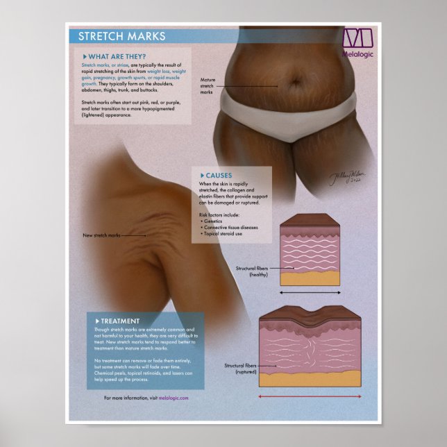 Melalogic Stretch Marks Medical Poster (Front)