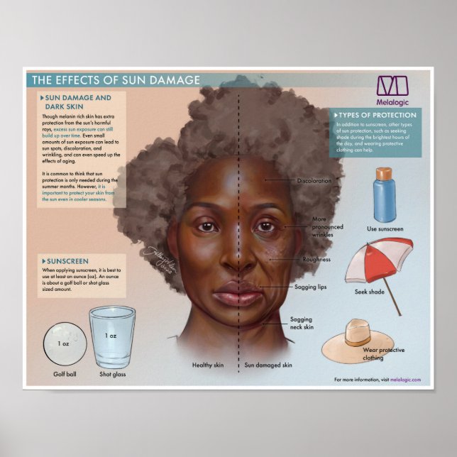 Melalogic The Effects of Sun Damage Medical Poster (Front)