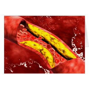 Microscopic View Of Fat Plaque Inside The Artery