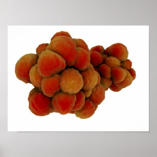 Microscopic View Of Tumour 4 Poster