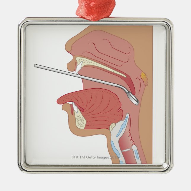 Mirror Laryngoscopy Metal Tree Decoration (Front)