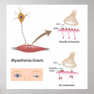 Myasthenia Gravis eye Poster