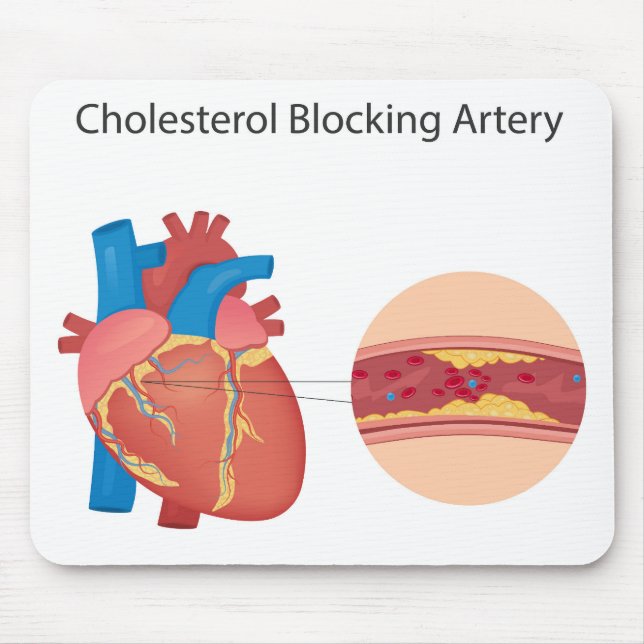 Narrowed blood vessels mouse pad (Front)