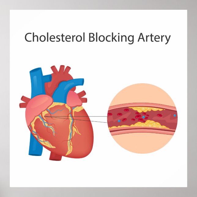 Narrowed blood vessels poster (Front)
