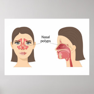  Nasal polyps Poster