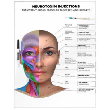 Neurotoxin Injection Dry Erase Board