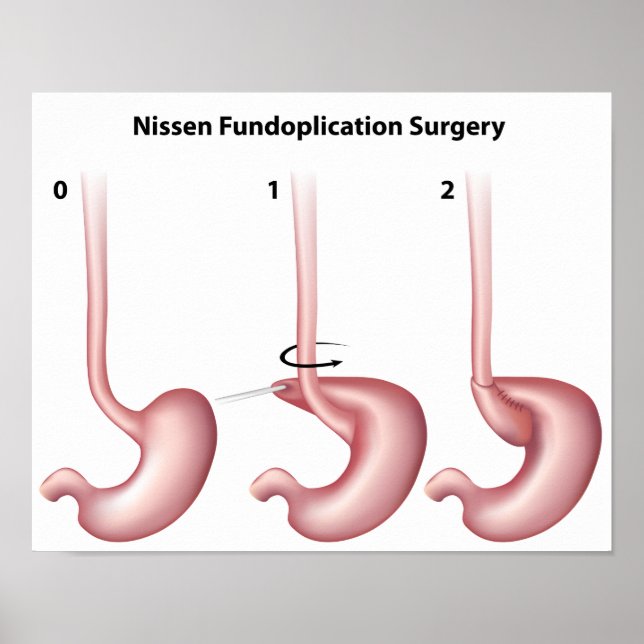 Nissen Fundoplication stomach Surgery  Poster (Front)