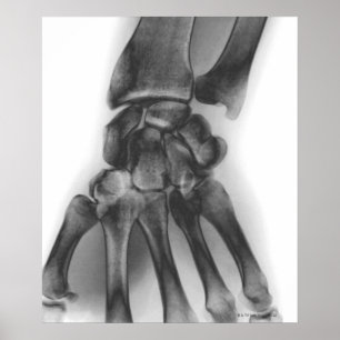 Normal wrist, X-ray Poster