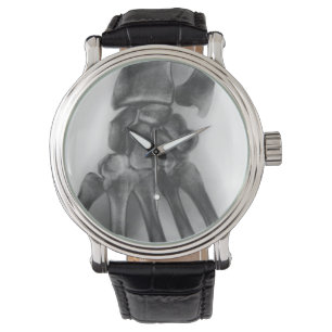 Normal wrist, X-ray Watch