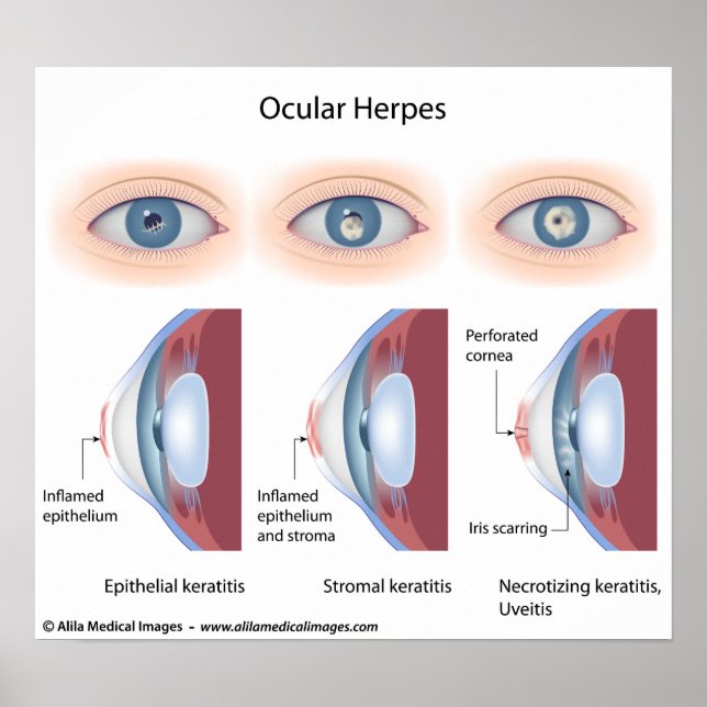 Ocular herpes infection, labelled diagrams poster (Front)