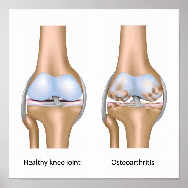 Osteoarthritis of knee joint Poster (Front)