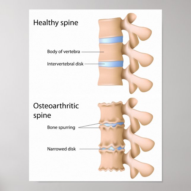 Osteoarthritis of the spine Poster (Front)