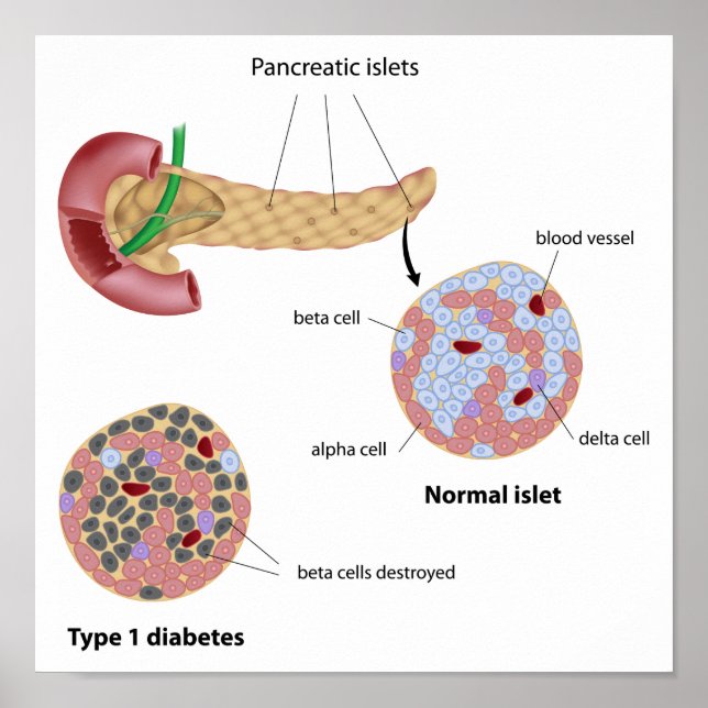 Pancreatic islet and diabetes Poster (Front)