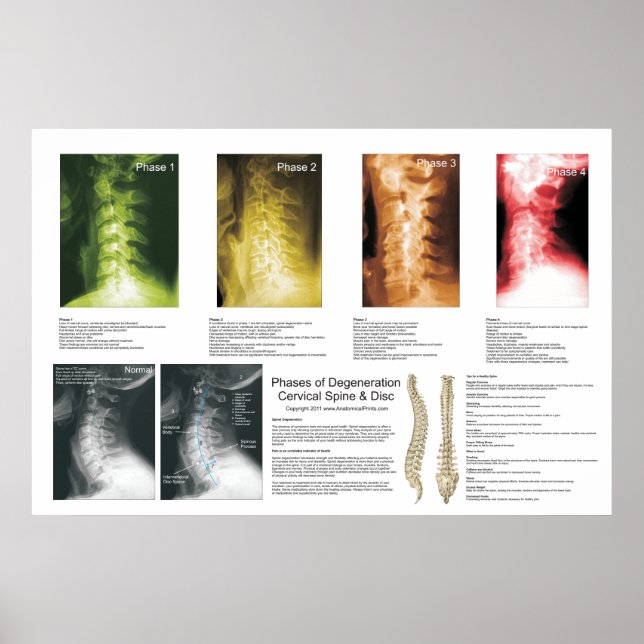 Phases Cervical Spinal Degeneration Poster (Front)