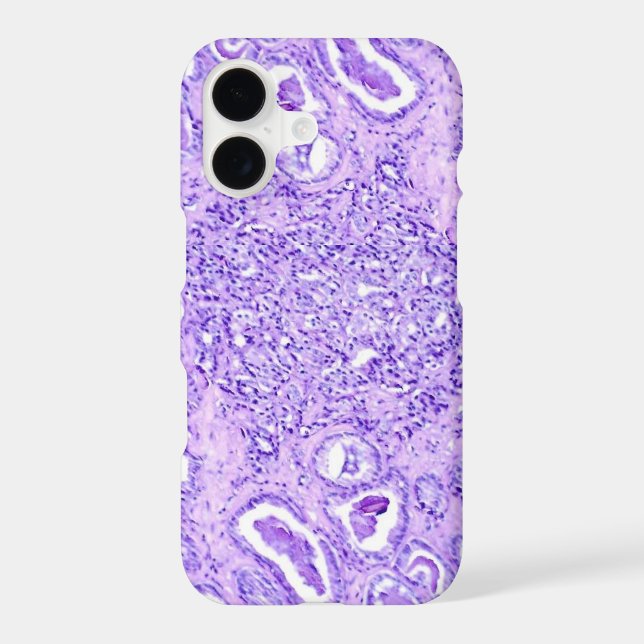 Phone Case(many models)-Prostate Cancer Cells (Back)