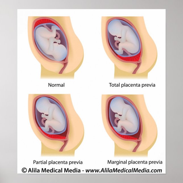 Placenta previa poster (Front)