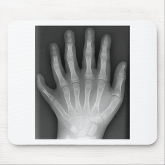Polydactyly, Six Fingered Hand, X-Ray, rarity! Mouse Pad