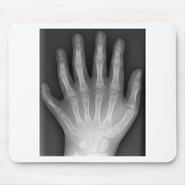 Polydactyly, Six Fingered Hand, X-Ray, rarity! Mouse Pad (Front)