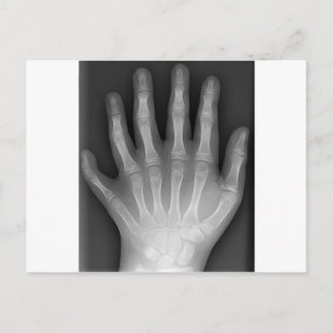 Polydactyly, Six Fingered Hand, X-Ray, rarity! Postcard