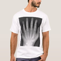 Polydactyly, Six Fingered Hand, X-Ray, rarity!