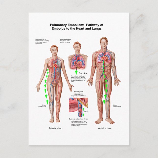 Pulmonary Embolism, Pathway Of Embolus Postcard (Front)