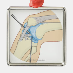 Rigid Endoscopy Procedure Metal Tree Decoration