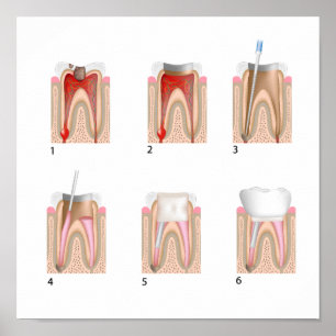 Root canal treatment Any size Poster